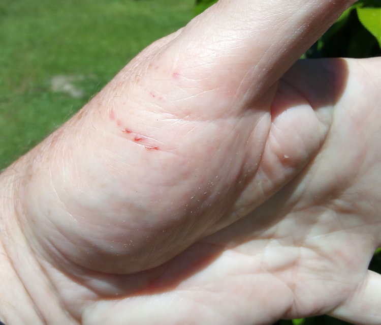 cleaned bite at base of thumb  from eastern racer Coluber constrictor